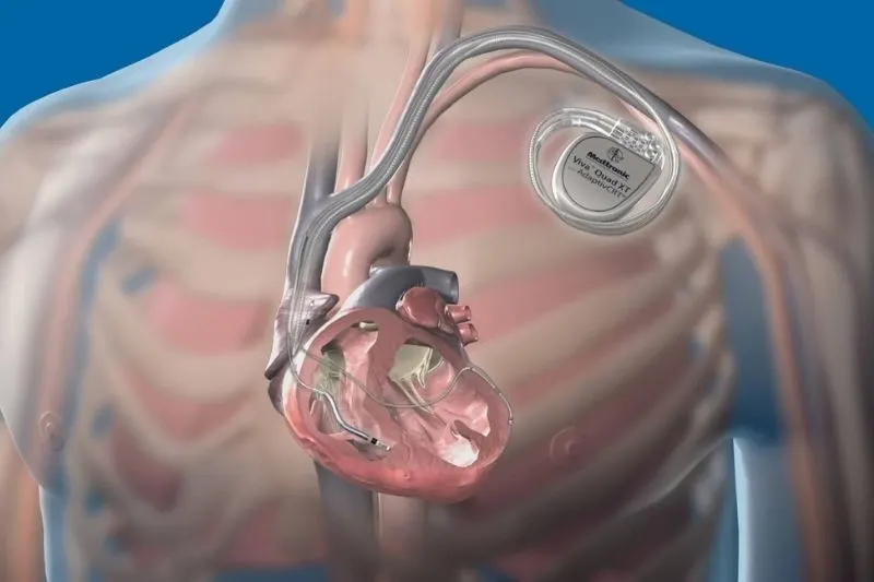 implanted cardioverter defibrillator (ICD)