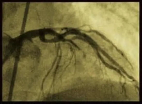angioplasty blocked artery