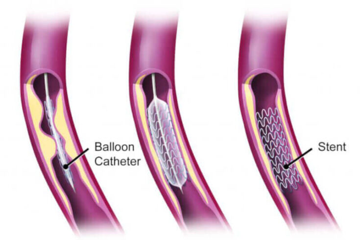 Angioplasty And Stent Your Practical Exercise Guide 2023