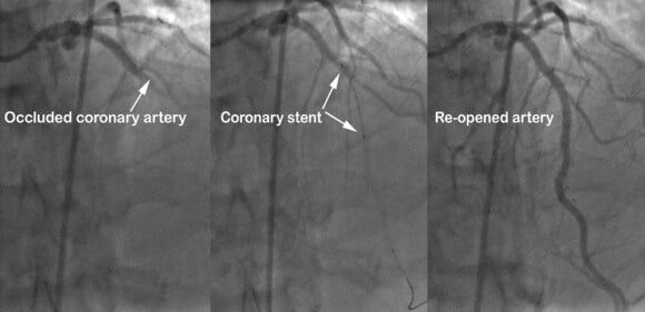 angioplasty and stent in images