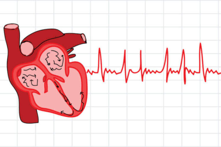 Atrial Fibrillation Exercise Guidelines By Dr Bill Sukala 0667