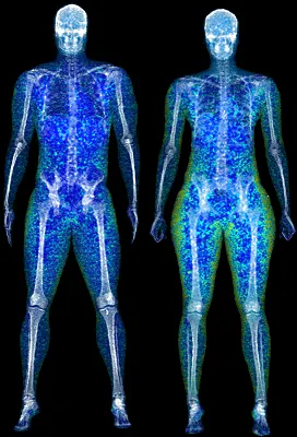 dexa scan body composition body fat