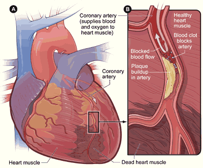 heart attack myocardial infarction