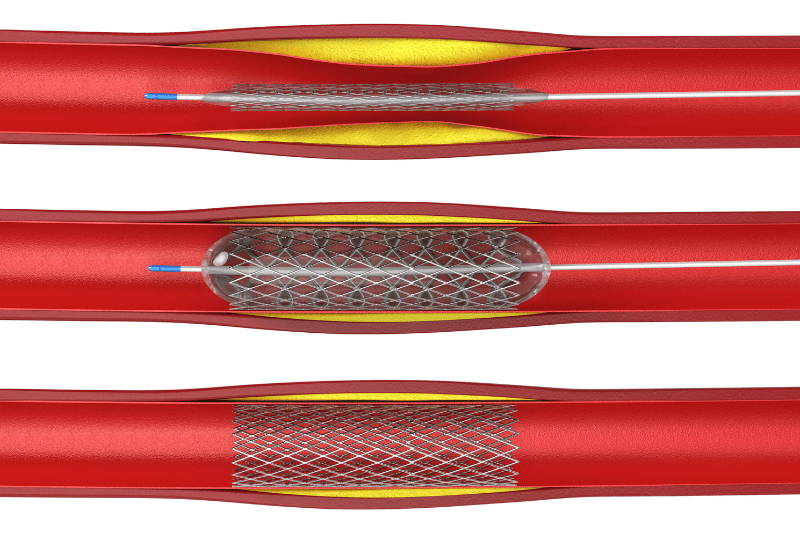 angioplasty procedure images